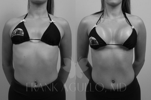Editorial frontal before and after view of a Motiva Preserve breast augmentation with 315cc Motiva Ergonomix Full implants on a slim athletic young woman patient wearing a Dr. Worldwide bikini, breast augmentation by Dr. Frank Agullo, MD, FACS, double board-certified plastic surgeon at Southwest Plastic Surgery in El Paso, Texas.